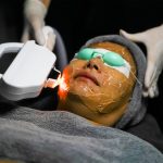 Facial Hair Removal Treatment by Diode laser